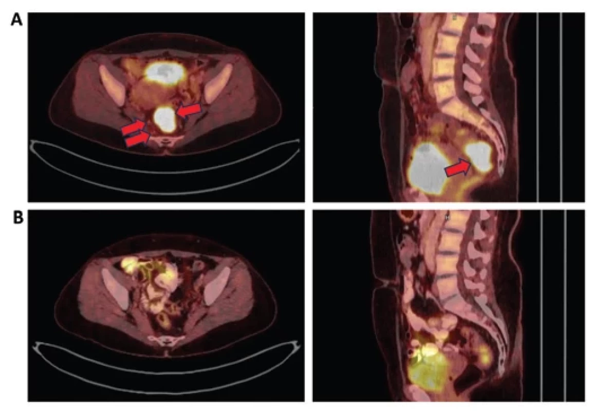 PET/CT pánve před zahájením terapie v 3/2023 a po dokončení neoadjuvantní terapie v 6/2023.