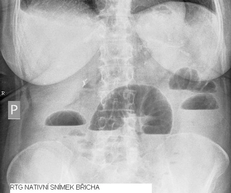 RTG nativní snímek břicha
Fig. 1. Native abdominal x-ray