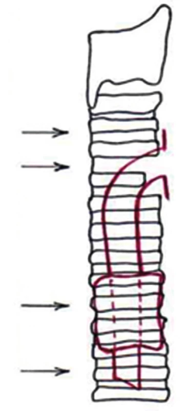 Příčiny benigních stenóz
Fig. 3: Causes of benign stenoses