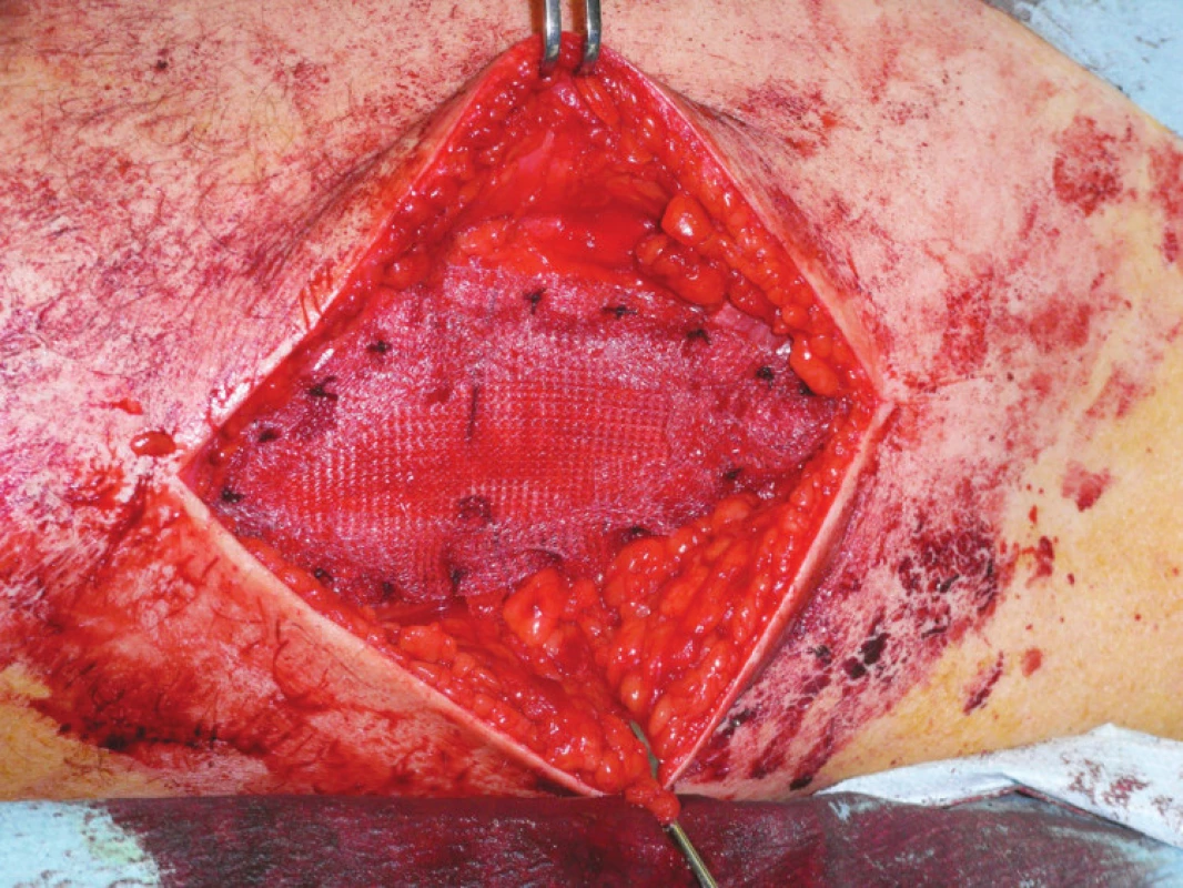 Riešenie defektu donorského miesta po dobratí fascie laty polypropylénovou sieťkou
Fig. 4. Management of the fascia lata donor site defect, using a polypropylene mesh