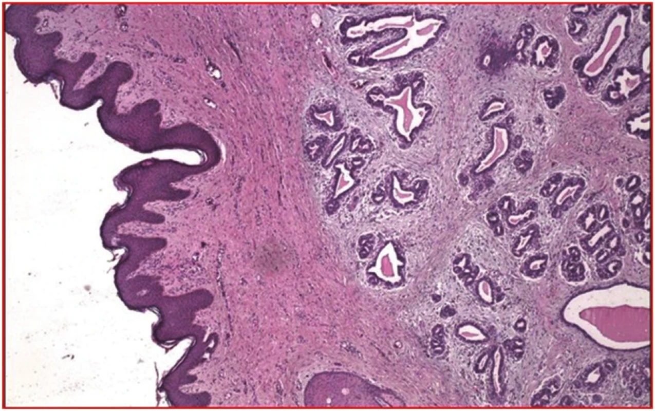 Dilatované vývody a atrofické lobuly heterotopickej mliečnej žľazy vo výrazne kolagenizovanej stróme (hematoxylín, eozín; 100x)
Fig. 6: Dilated ducts and atrophic lobules of heterotopic mammary gland in significantly collagenized stroma (hematoxylin, eosin; 100x)