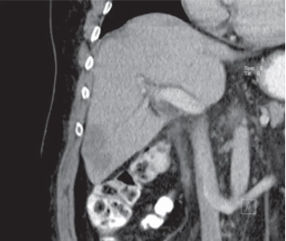  Frontální CT scan – metastatický rozsev maligního melanomu v levém jaterním laloku. Fig. 2. Frontal CT scan – metastatic spread of malignant melanoma  in the left hepatic lobe.