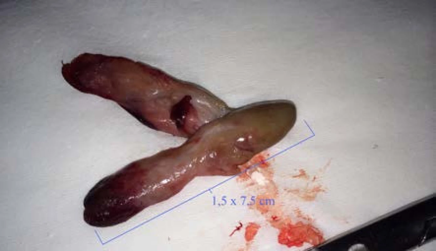Nádor vypuzený z uretry
Fig. 2. Tumor expelled from the urethra
