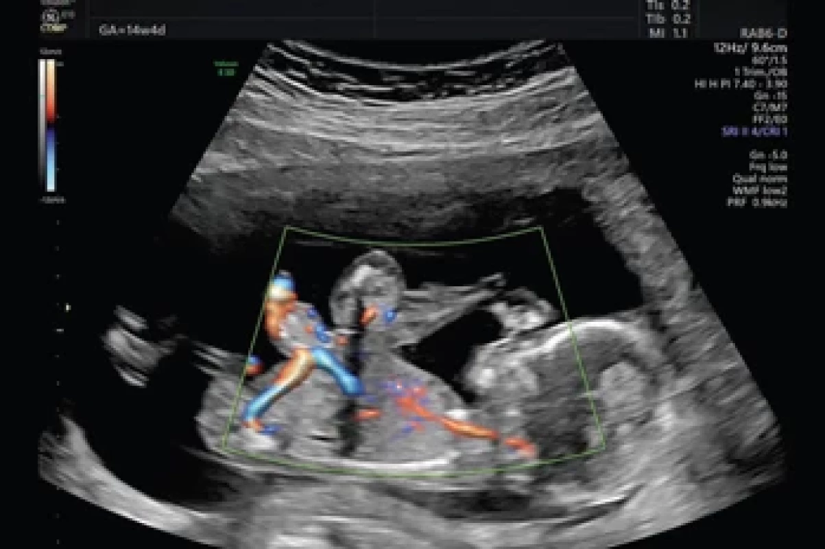Mode with color fl ow mapping ultrasound image at 14th weeks of gestation showing a parasitic fetus connected at the midline to the anterior abdominal wall of the autosite through soft tissue with weak vascularization. The soft tissue of the umbilical cord contained a total of fi ve vessels – three in the umbilical cord of the autosite and two in the umbilical cord of the parasite.