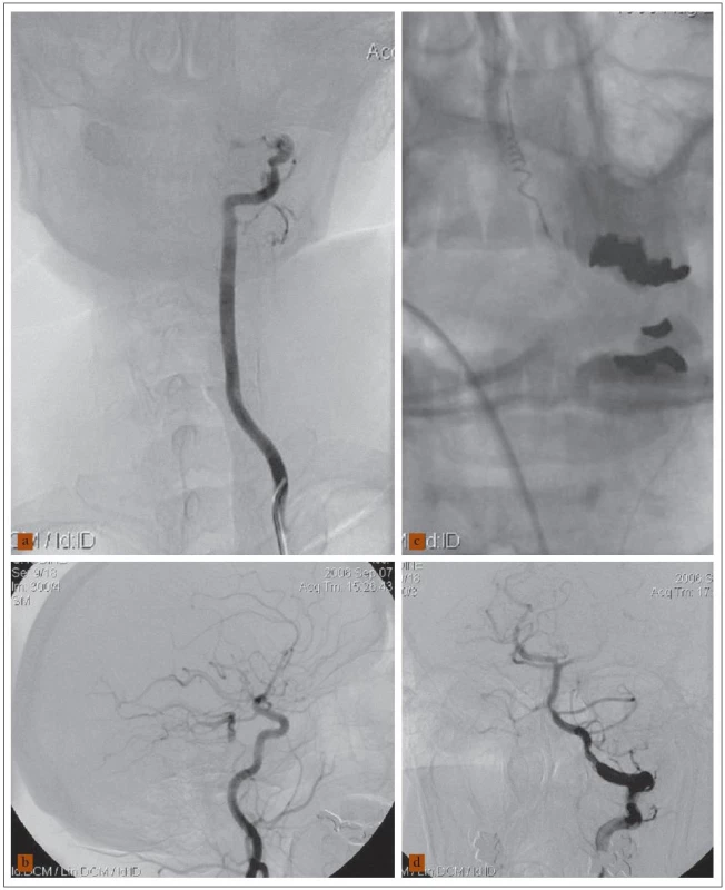 58letý muž a akutní vertebrobazilární ischemií, kvadruparézou, deviací bulbů, arteficiálně ventilován.
a) Angiogram levé vertebrální tepny ukázal uzávěr jejího intrakraniálního úseku a neplnění a. basilaris (a. vertebralis dx. intrakraniálně uzavřena – není na obrázku). b) Angiogram levé karotické tepny zobrazil plnění distálního úseku a. basilaris, aa. cerebri post. a aa. cerebelli post. přes a. comm. posterior. c) Rozvinutá spirálka Merci zařízení v oblasti embolu a. basilaris. d) Angiogram levé vertebrální tepny po extrakci embolu ukázal průchodné vertebrobazilární řečiště. Nemocný tři měsíce po léčbě mRS 2.