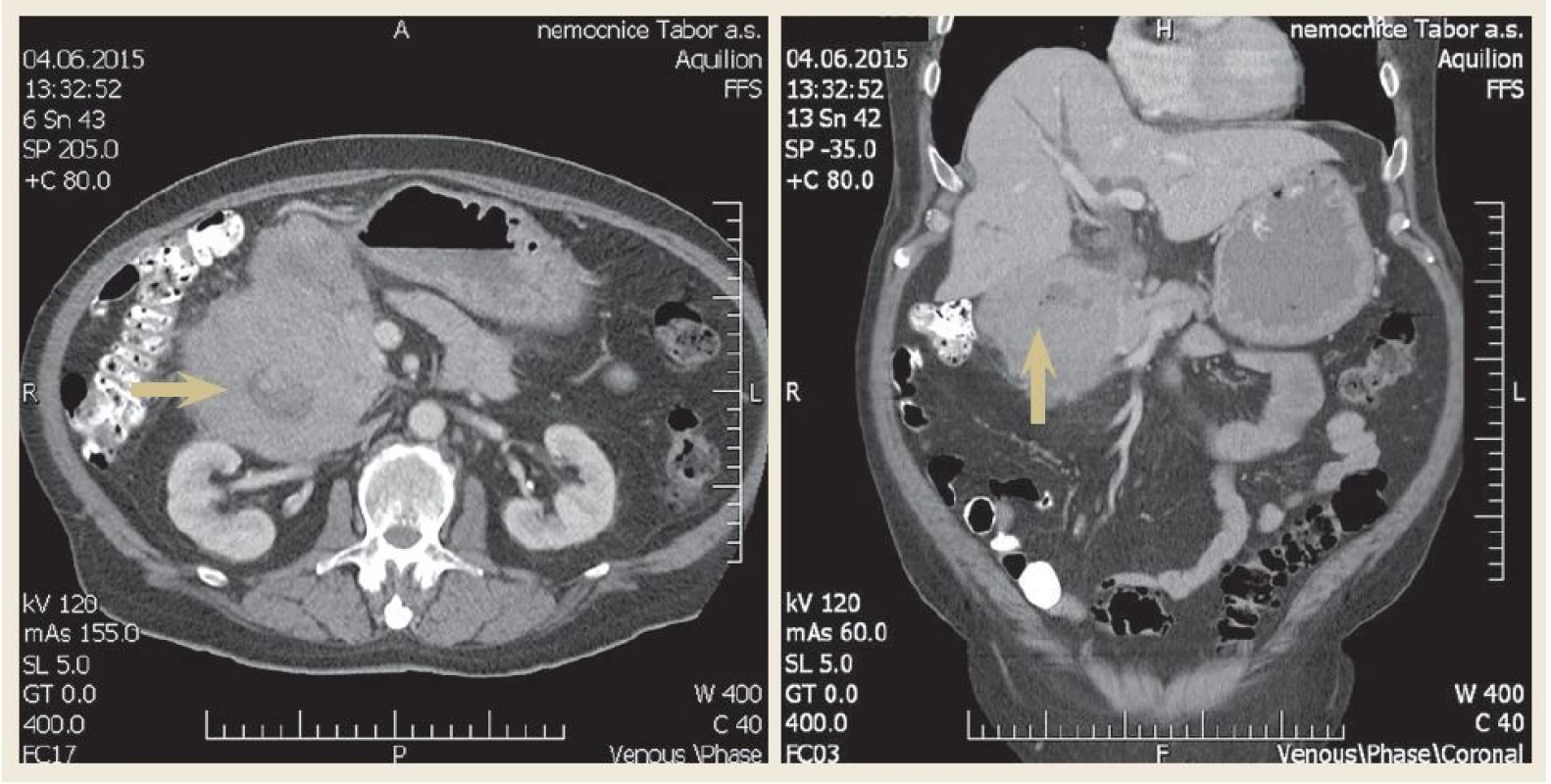 Axiální a koronární řez – CT břicha demonstrující objemnou tumorózní masu v oblasti D1 a D2 (šipka).
Fig. 2. Axial and coronal view – computer tomography of scan of abdomen demonstrating a large mass in the first and second part of the duodenum (arrow).