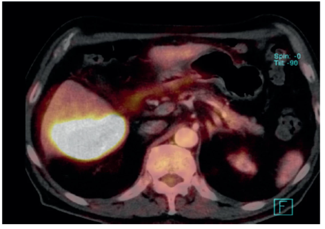 PET – CT: vysoce metabolicky aktivní útvar tumorózního vzhledu obklopující dolní okraj pravého jaterního laloku
Fig. 2: PET-CT: a highly metabolically active structure with the appearance of a tumour surrounding the lower margin of the right liver lobe