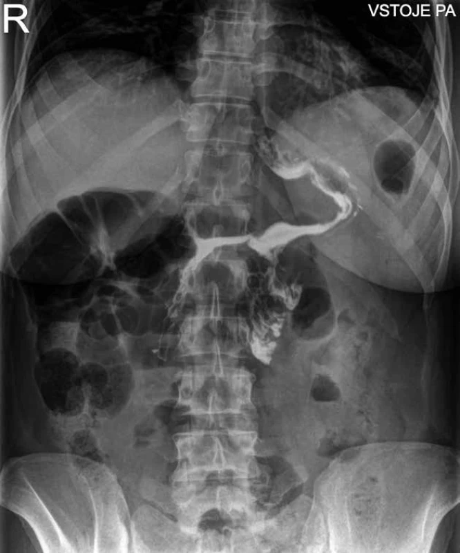SASJ – pooperační rtg s vodným kontrastem    Fig. 3: SASJ – postoperative water soluble contrast radiography