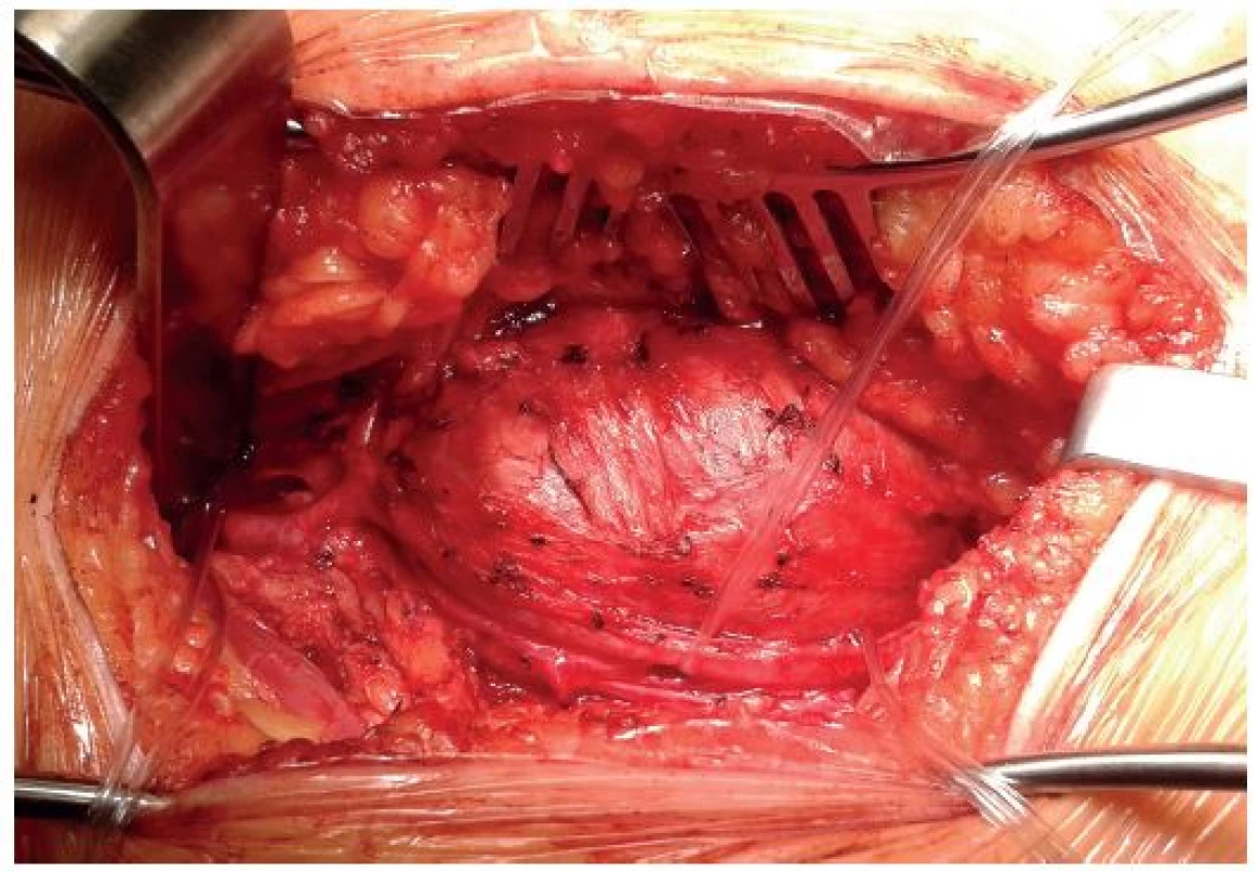 Peroperační nález popliteální tepny natažené přes pseudoaneuryzma
Fig. 3: Intraoperative finding of the popliteal artery stretched over the pseudoaneurysm
