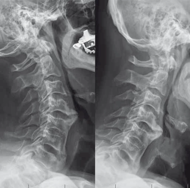 Předoperační funkční RTG (kazuistika 2).
Fig. 7. Preoperative functional X-ray (a case report 2).