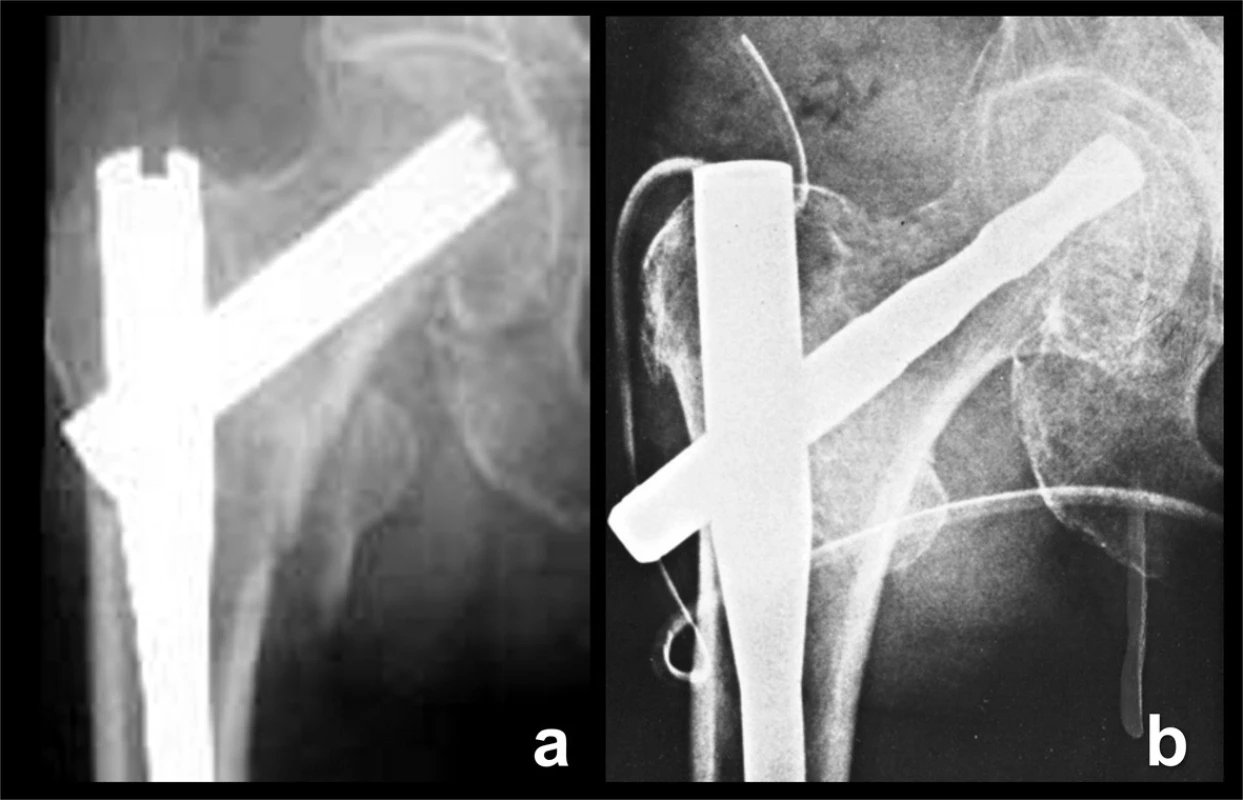 Skluzné čepele: a – Gliding nail, čepel tvaru H; b – PFN-A, spirální čepel.
Fig. 6: Gliding blades: a – Gliding nail, H-shaped blade; b – PFN-A, spiral blade.
