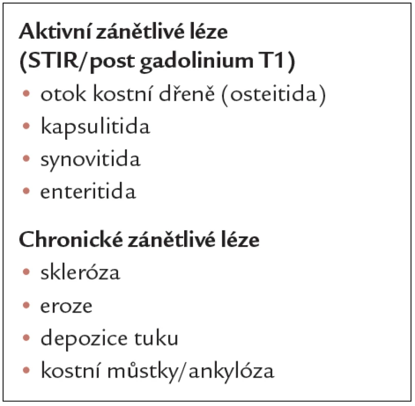 Typické léze na sakroiliakálních kloubech u spondyloartritid při hodnocení MRI.