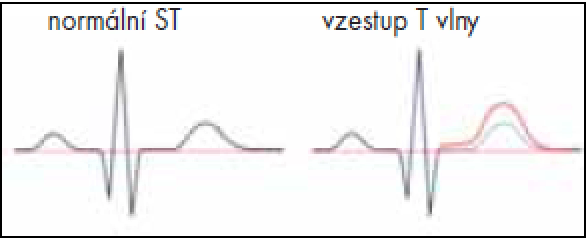 Vzestup vlny T.