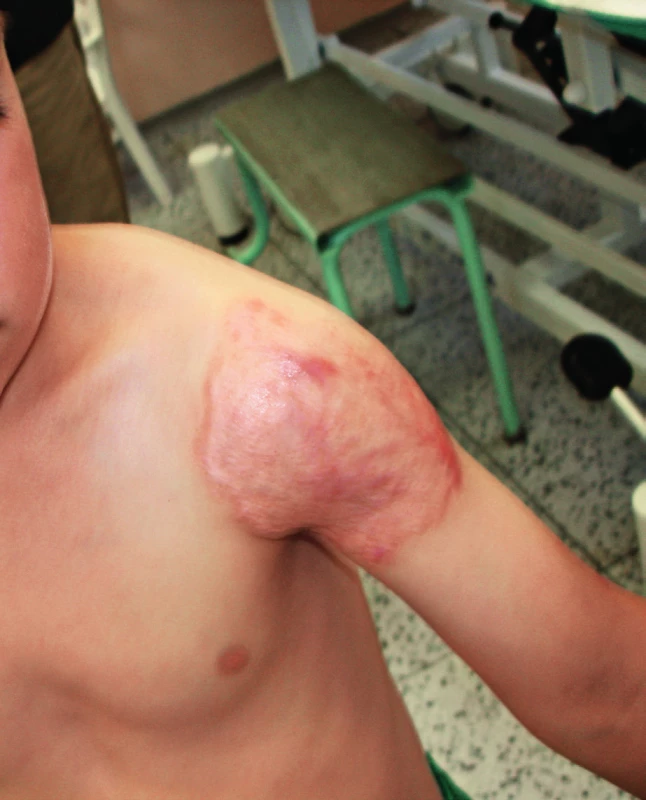 Hojení ložiska plošnou jizvou v závěru 14měsíční terapie.
Fig. 7. Site healing, 14 weeks after therapy initiation.