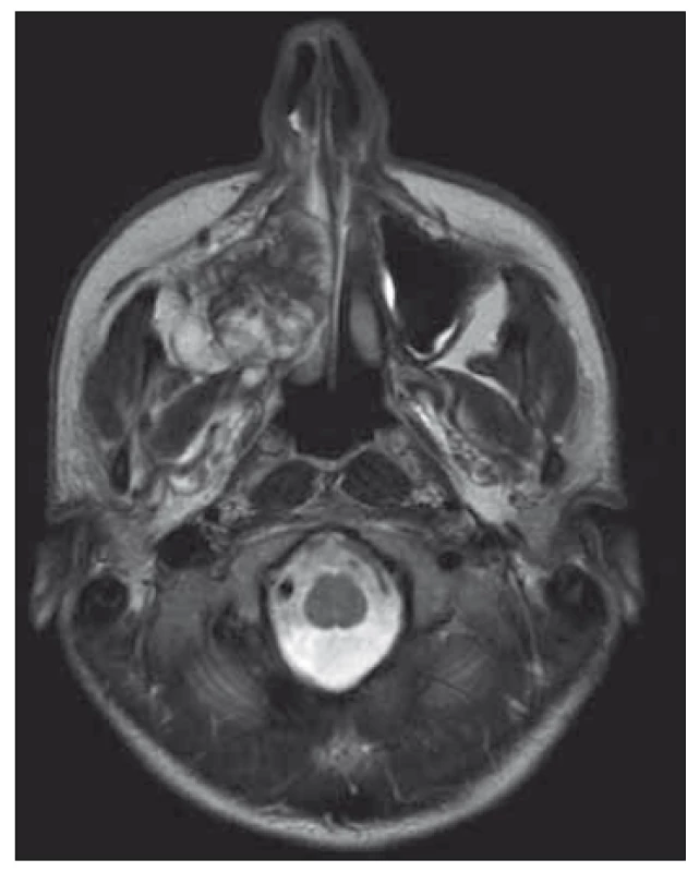 MRI transverse view – sarcoma in
the right maxilla, obstructing right part of
nose, deviating nasal septum and expanding
into infratemporal fossa.<br>
Obr. 2. MR příčný/transverzální pohled –
sarkom v pravé maxile, obstrukce pravé
části nosu, odklonění nosní přepážky
a rozšíření do infratemporální fossy.