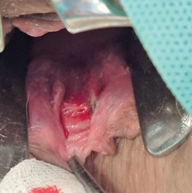 Chronická fisura anu při zadní komisuře s navalitými okraji.  Chronic anal fissure toward the coccyx with indurated  margins.