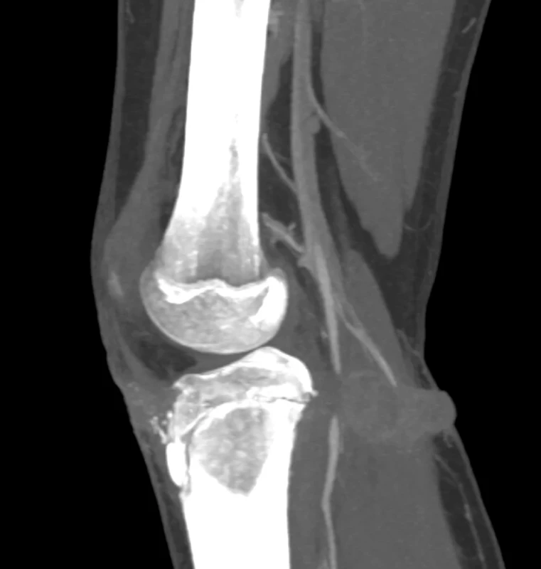 CT angiografie s defektem v náplni popliteální tepny 