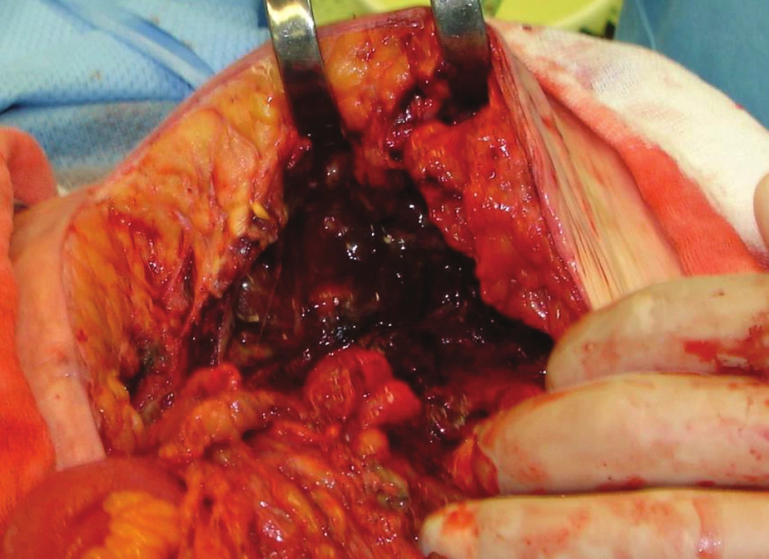 Abscesová dutina
Fig. 1. Absces cavity