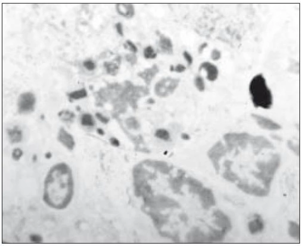 Imunohistochemické vyšetření: exprese S-100 proteinu v Langerhansových buňkách, zvětšeno 400krát.