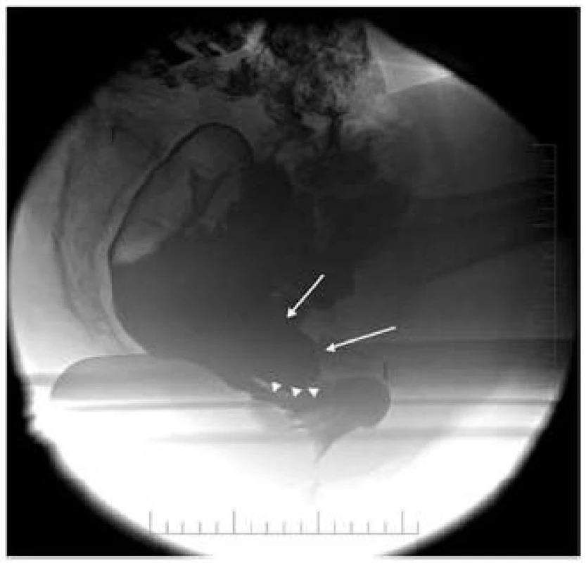 Symptomatická enterokéla podílející se na obstrukci anorektální junkce.
Fig. 6. A symptomatic enterocele inducing obstruction of ano-rectal junction.