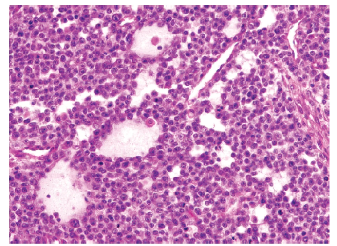 Kazuistika <b>1</b>. Ložiskové rozvolnění původní struktury vytvářející nezvyklé organoidní mikrocystické resp. pseudoglandulární uspořádání (HE, 400x).