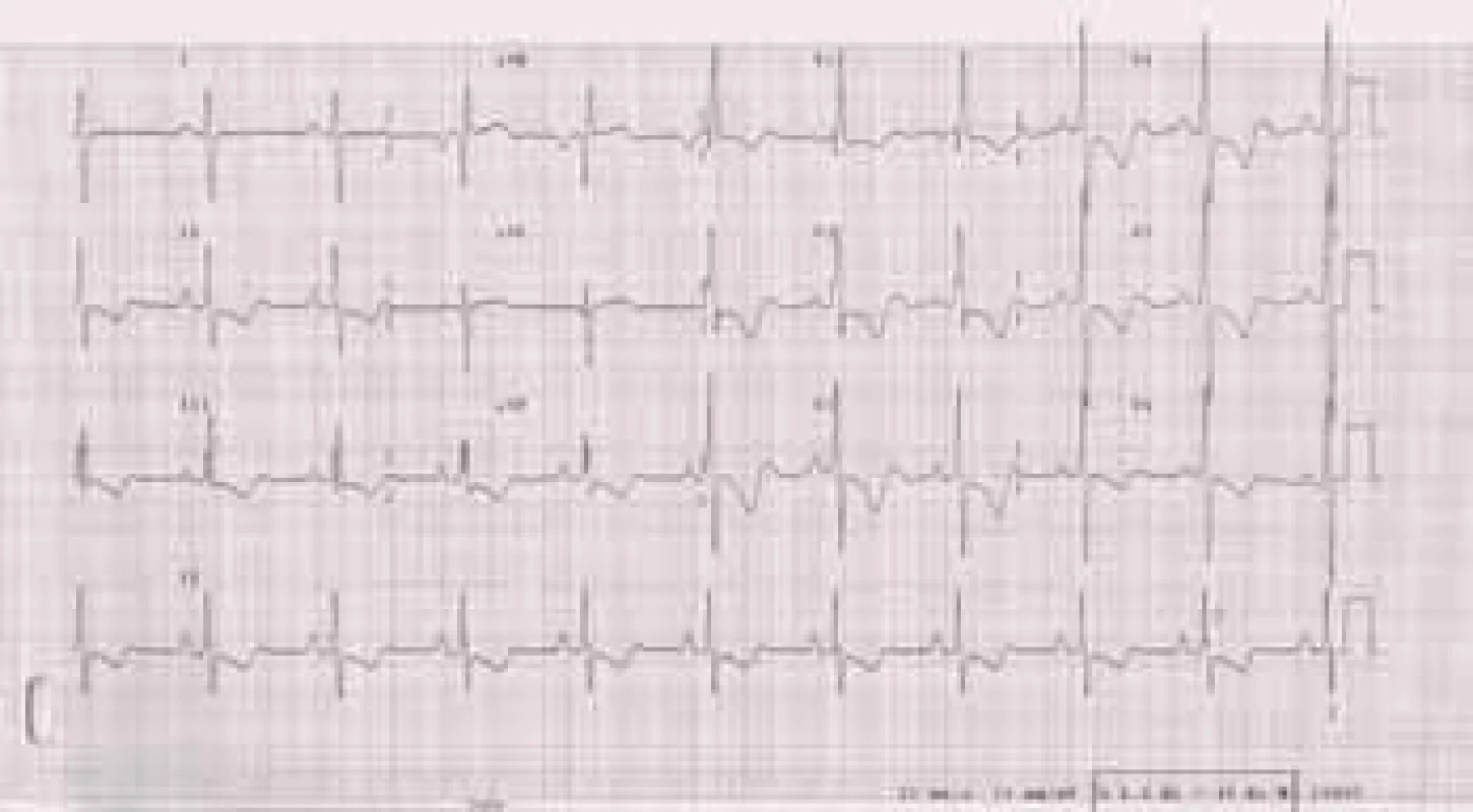EKG u nemocné s těžkou plicní arteriální hypertenzí: P pulmonale. R/S ve V1 > 1, inkompletní blokáda pravého raménka Tawarova, naznačené deprese ST a negativní T ve svodech II, III, aVF, V1-6.