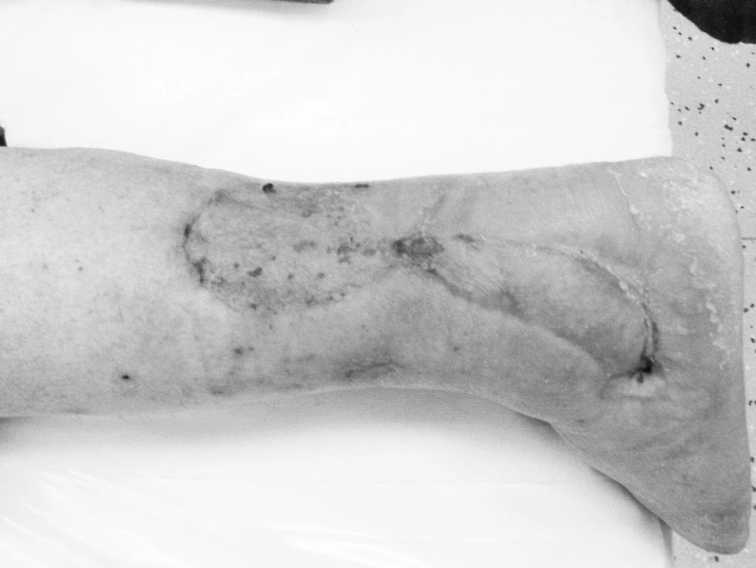 Stav po 6 týdnech
Pic. 4. 6 weeks later