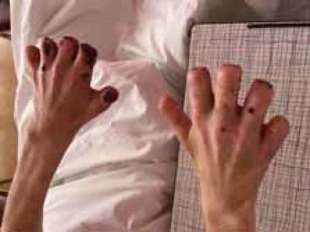 The appearance of hands. A day before discharge (frontal view).