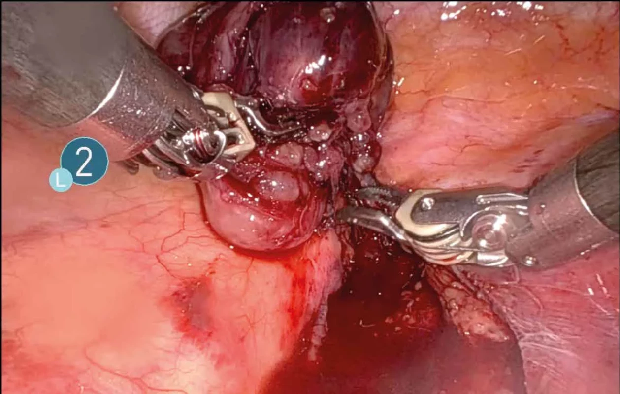 Preparace tumorózního ložiska    Fig. 3: Tumour preparation