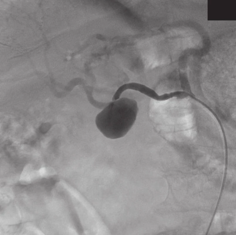 AG nález pseudoaneuryzmatu a. hepatica 
Fig. 2: Angiographic finding of pseudoaneurysm of hepatic artery