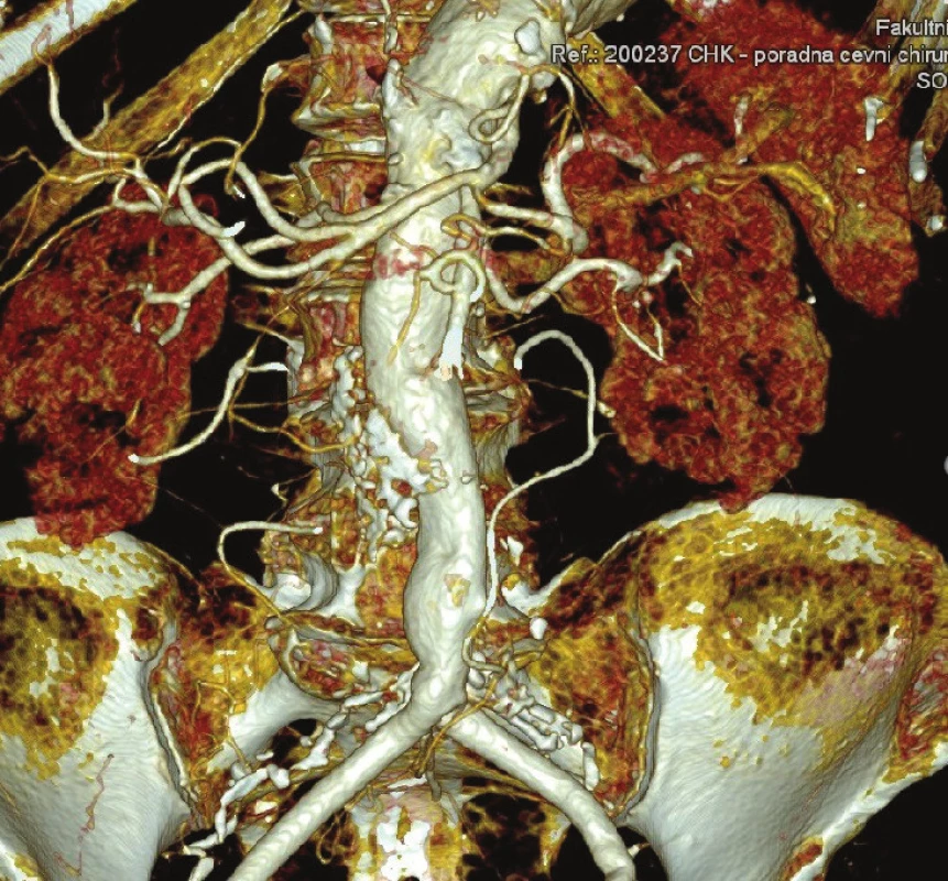 CTA kontrola 1,5 roku po výkonu
Fig. 10: Follow-up CTA 1.5 years after surgery