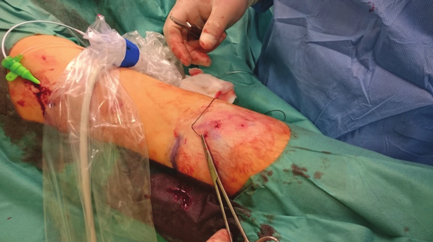 Zakreslená žíla na kůži, drobné incize, pasáž jehly pod žilou
Fig. 1: The vein is marked on the skin, a small incision is made and the needle passes under the vein