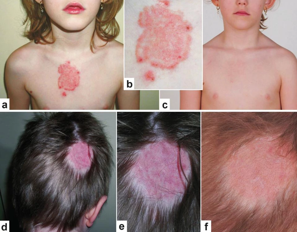 Tinea corporis a tinea capitis u sourozenců
