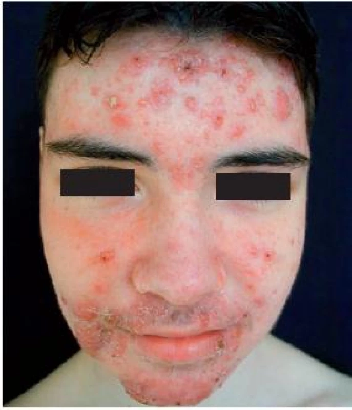Acne vulgaris conglobata před léčbou (Foto M. Hašková)