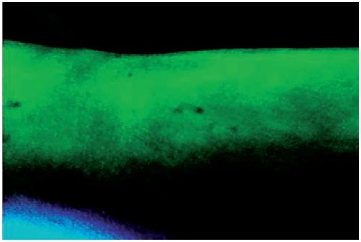 Fluorescence ložisek pityriasis versicolor ve Woodově světle