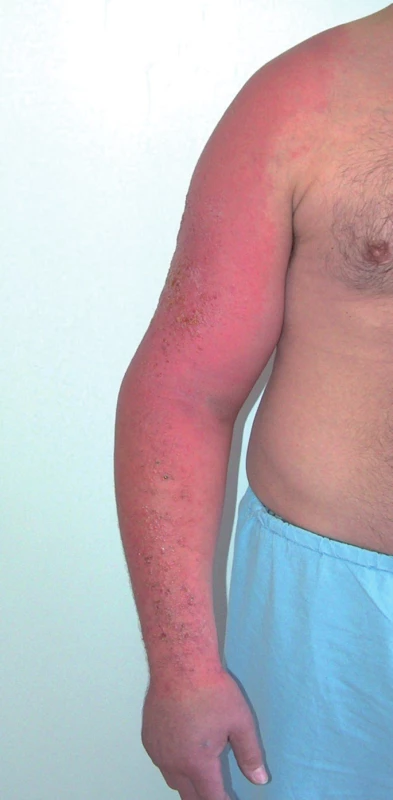 Fotoalergická kontaktní dermatitida na pravé paži a na rameni (ketoprofen).