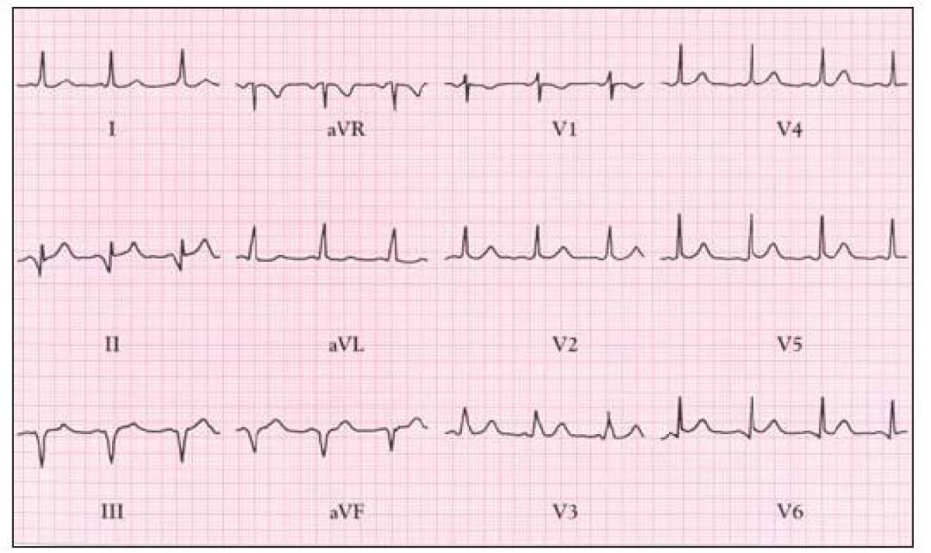Syndrom preexcitace je přítomen u 20–25 % pacientů s Ebsteinovou anomálií. EKG ukazuje krátké P–Q a pravokomorovou preexcitaci.