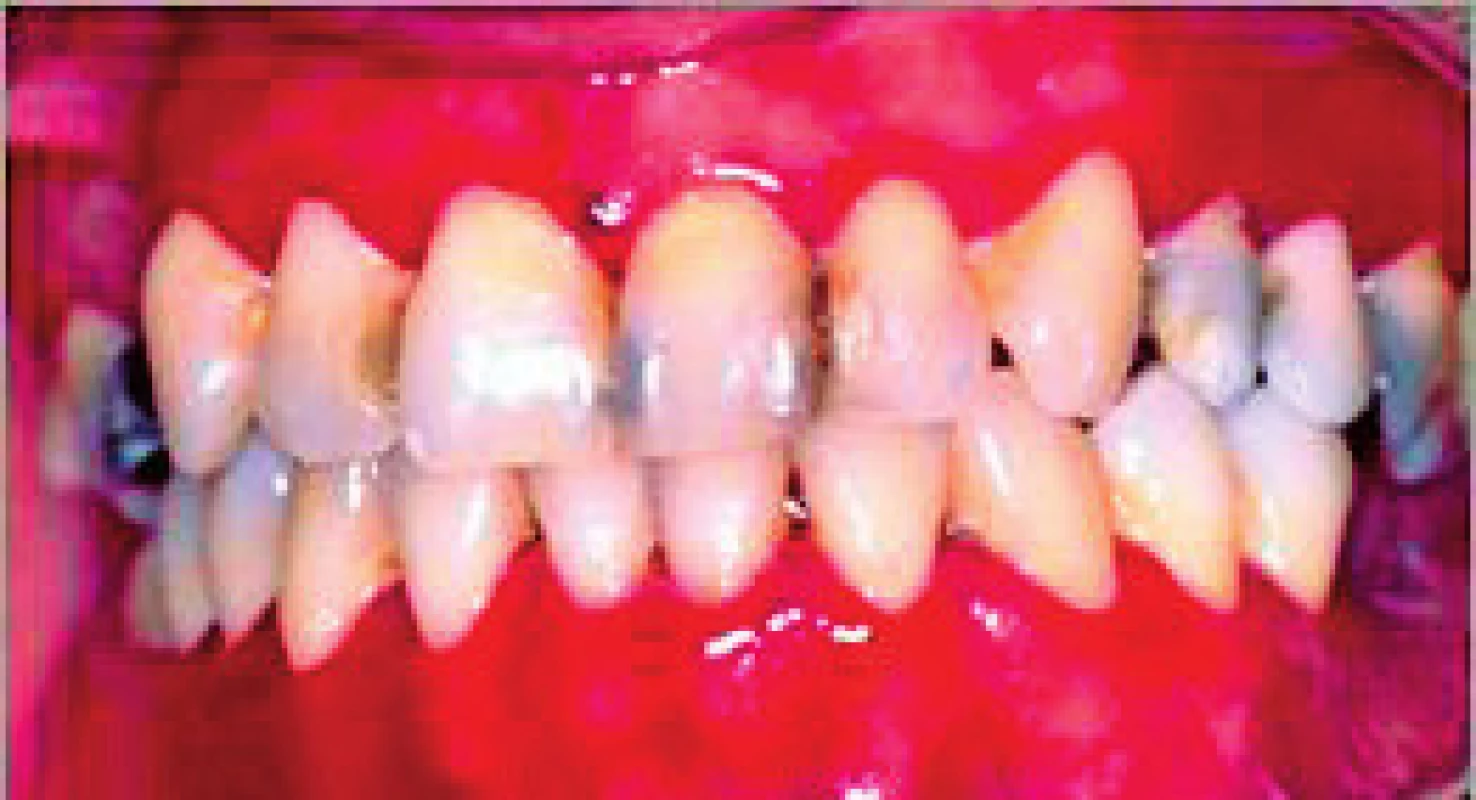 Gingivitis desquamativa ako predchádzajúci stav vezikulárnej a erozívnej formy lichen planus (Ďurovič)