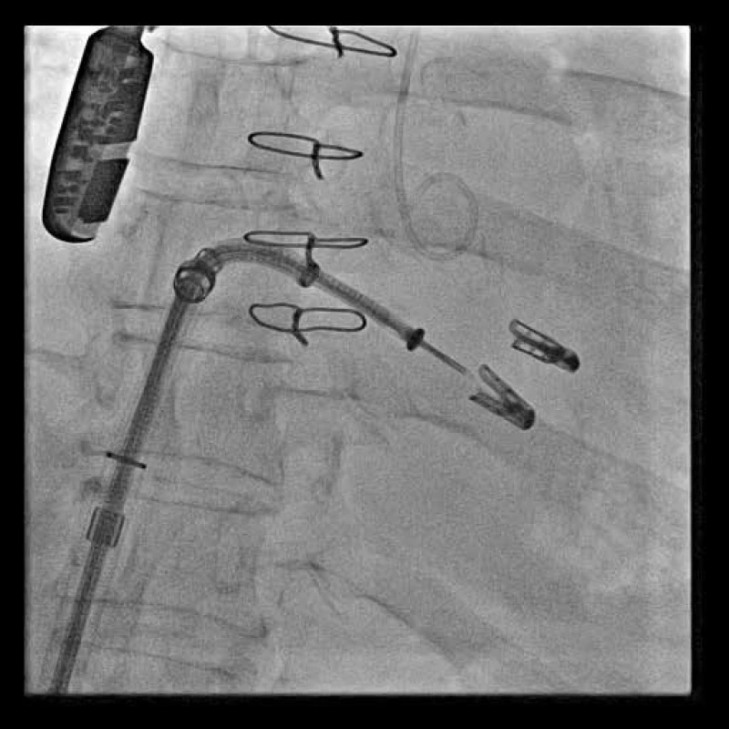 Skiaskopický obraz po implantaci dvou MitraClipu s ještě zavedeným zaváděcím katétrem v levé síni (krátce před jeho odstraněním).