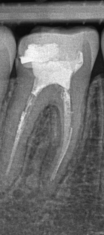 Zub s periapikálním projasněním u 16leté pacientky odeslané na ortodontické vyšetření (z archivu autora). Fig. 3 A tooth with periapical radiolucency in a 16-year-old female patient referred for orthodontic examination (from the author's archive).