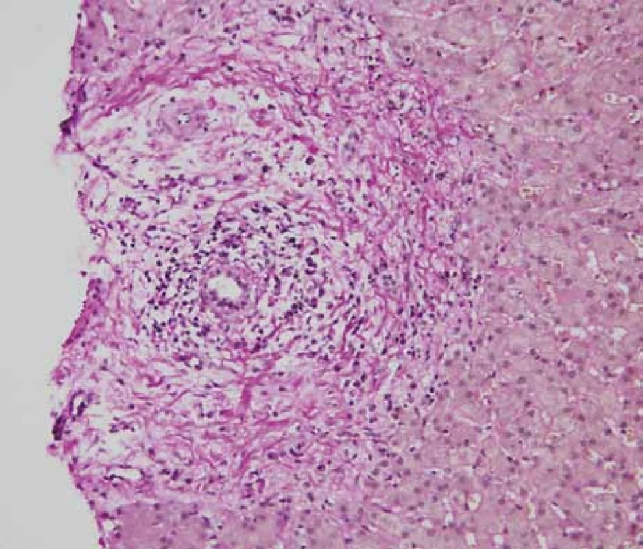 Jaterní biopsie – uzavřeno jako sklerotizující cholangitida s podezřením na autoimunitní onemocnění (nestejnoměrná infiltrace lymfoplazmocyty, v některých portálních traktech infiltrát prostupuje limitující ploténku, zejména kolem větších vývodů, které jsou ložiskově regresivně změněné, na příčných řezech typické vazivovité cibulovité formace).