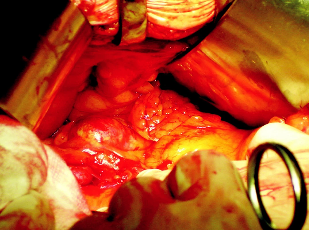 Peroperační nález u aneuryzmatu slezinné tepny
Fig. 3. An intraoperative finding of the lienal artery aneurysm