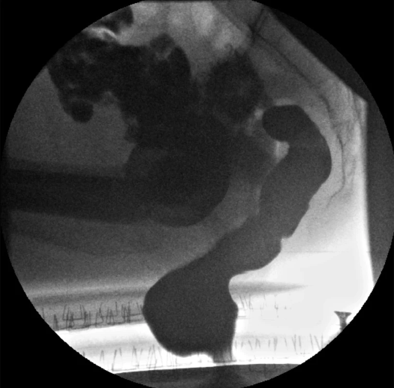 Ventrální rektokéla (snímek z dynamické defekografie)
Fig. 1: Ventral rectocele (dynamic defecography picture)
