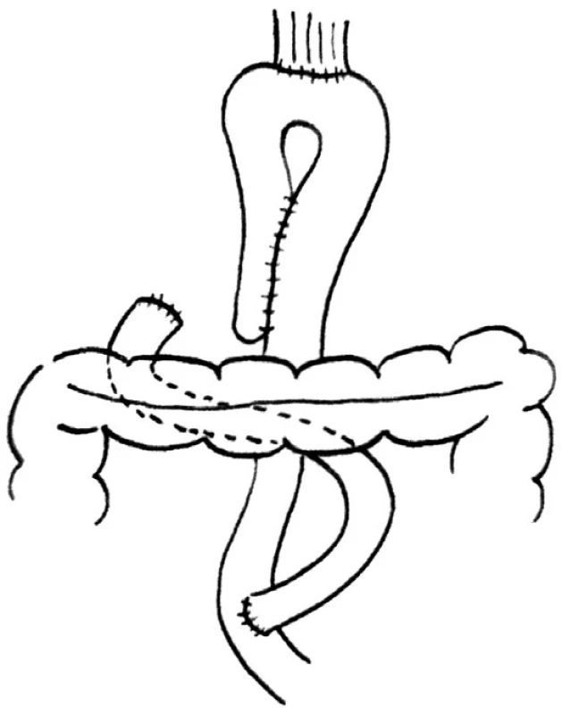 Huntova-Lawrencova-Rodinova rekonstrukce
Fig. 1. Hunt-Lawrence-Rodino reconstruction