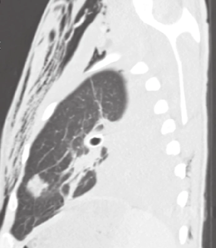 Průstřel levé plíce, hrudní drén v levém hemitoraxu, podkožní emfyzém, fluidotorax − sagitální řez
Fig. 2: The bullet channel in the left lung, chest drain in the left hemithorax, subcutaneous emphysema, fluidothorax − sagittal section
