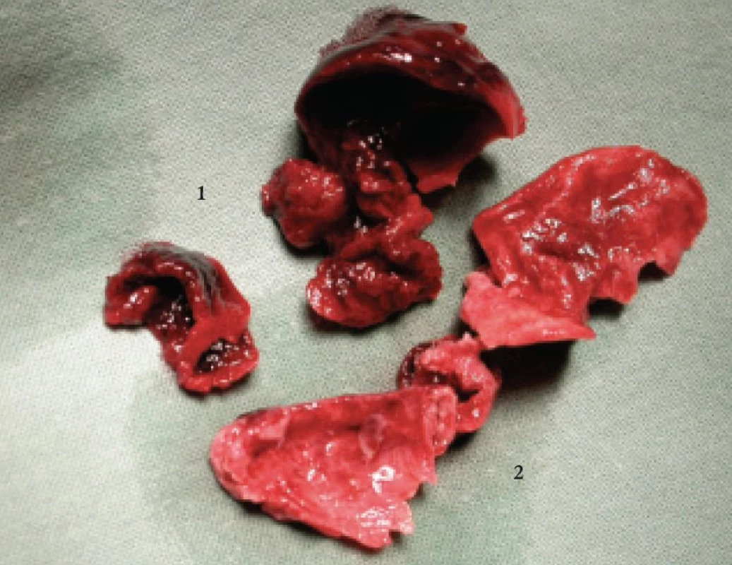 Tromboemboly různého stáří (1 – čerstvý tromboembolus, 2 – tromboembolus staršího data).