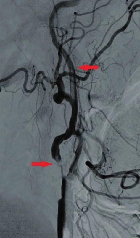 Angiografické zobrazení stenozy a volně vlajícího trombu
Fig. 4: Angiography presenting the stenosis and the free-floating thrombus