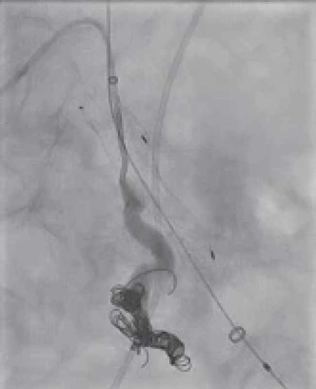 DSA (digitální subtrakční angiogram) – stav po embolizaci se zavedením spirálek a stentgraftu.