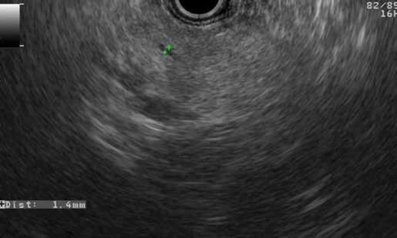 Normal EUS finding of pancreatic body parenchyma with a nondilated main pancreatic duct in a patient with GP (patient 2).
Obr. 4. Normálny EUS obraz parenchýmu tela pankreasu s nedilatovaným ductus Wirsungi u pacienta s GP (pacient č. 2).