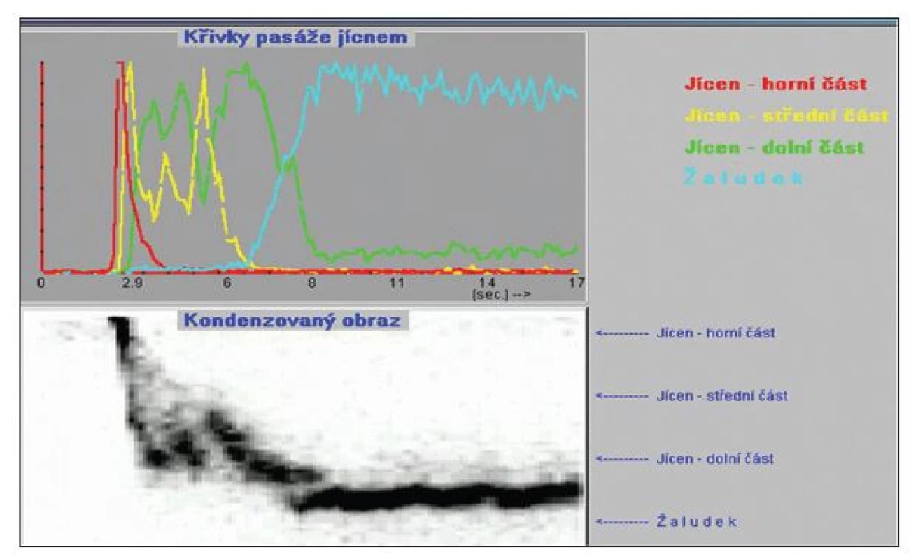 Dívka, 8 let, astma bronchiale, scintigrafie – antiperistaltika.